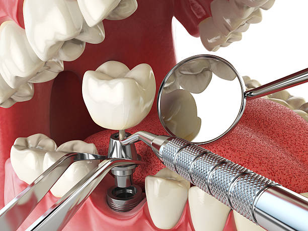Best Emergency Root Canal Treatment in Keshore, LA